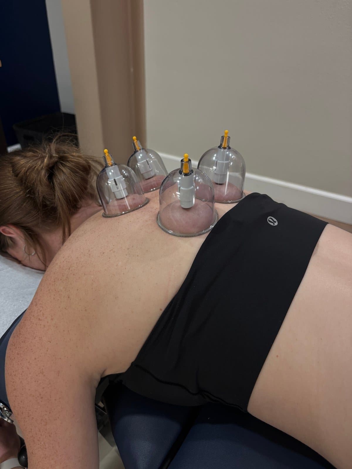 Cupping therapy